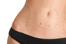 liposuzione addominale