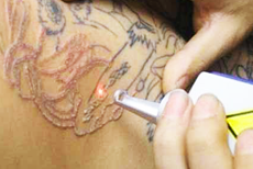 rimozione tatuaggi