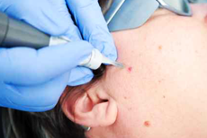 angioma