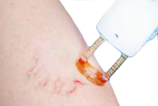 capillari gambe